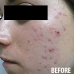 acne in face