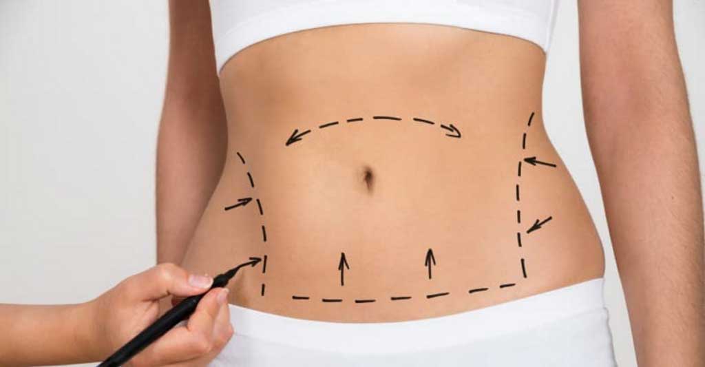 belly fat marking