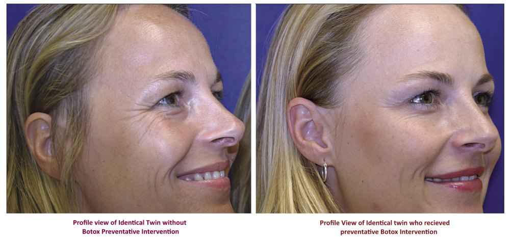 Before and after Botox