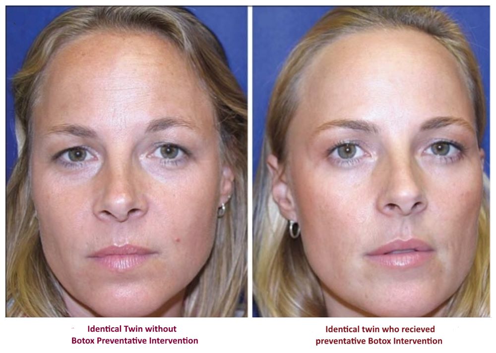 Before and after Botox