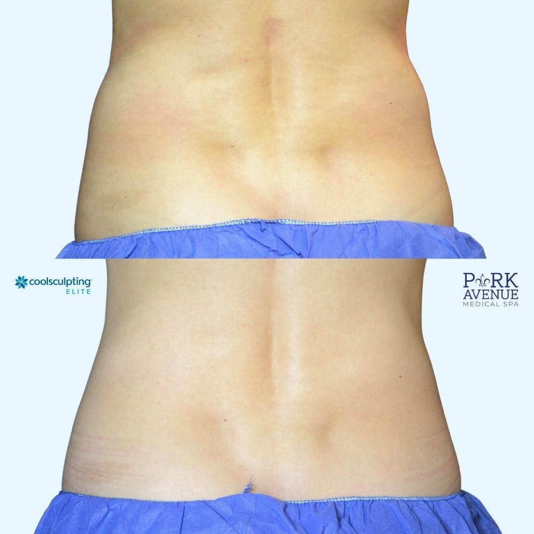 before and after photos of CoolSculpting on back