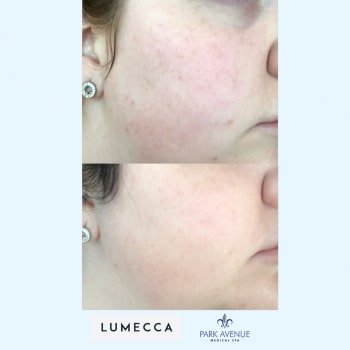 before and after photos of Lumecca treatment on face