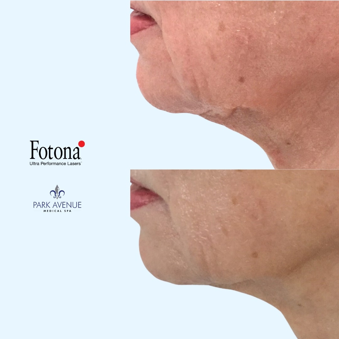 before and after photos of Fotona treatment on face