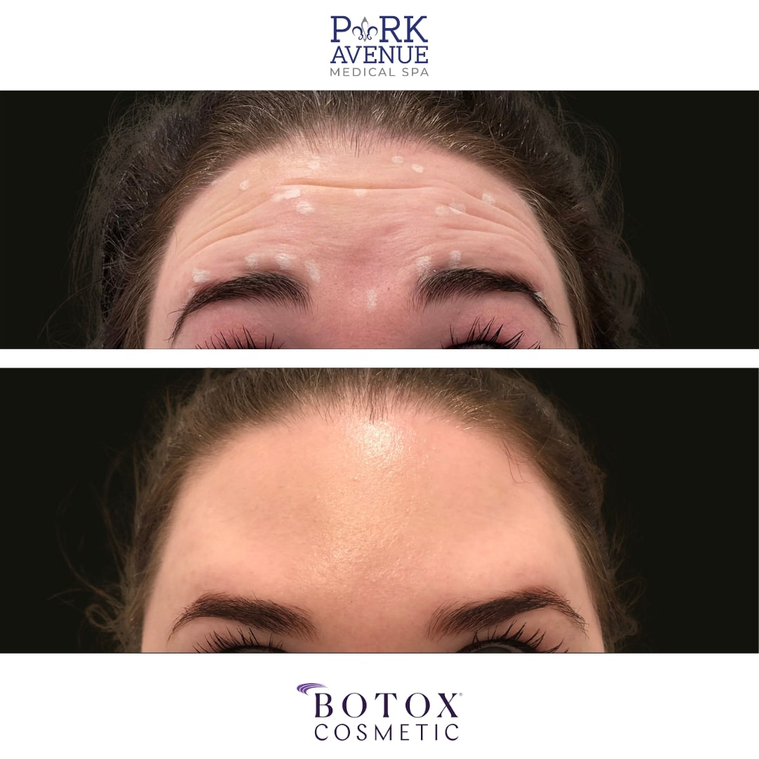 before and after photos of BOTOX treatment for woman