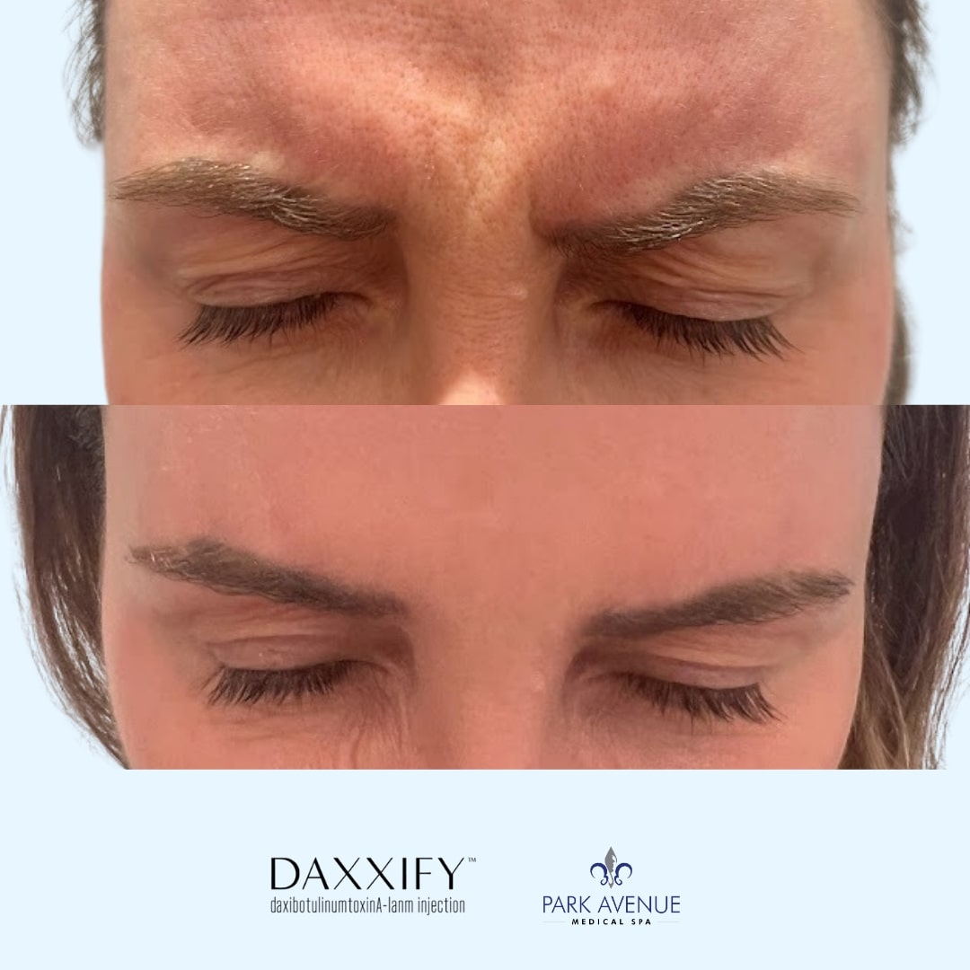 before and after photos of DAXXIFY treatment for woman