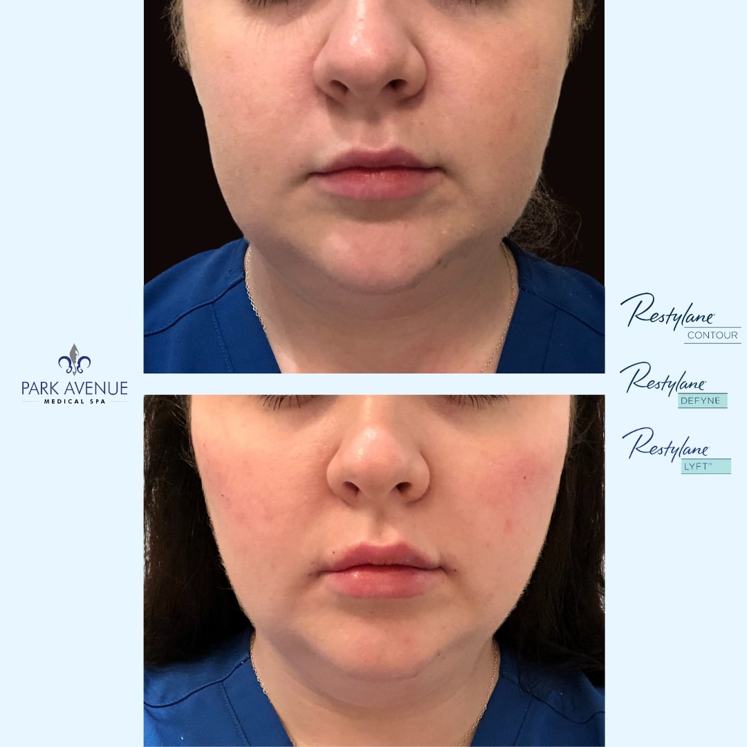 before and after photos of Restylane treatment for woman