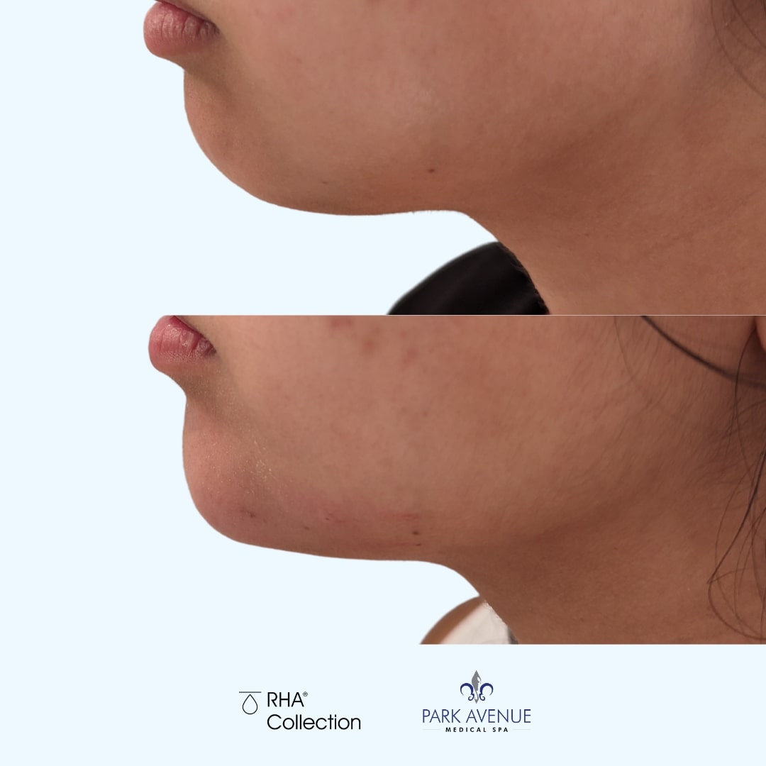 before and after photos of RHA treatment on chin