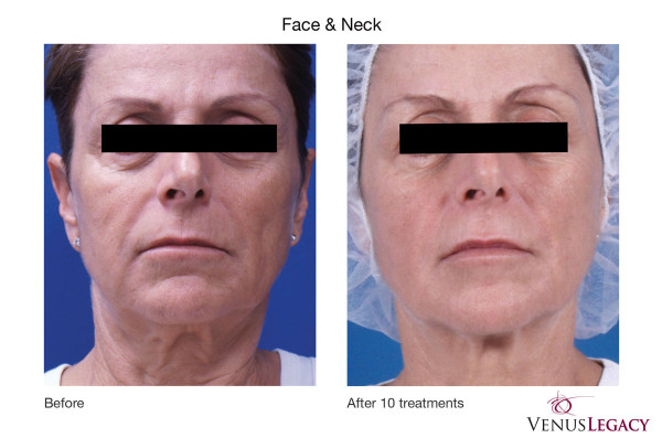 before and after photos of Venus Legacy treatment on face and neck