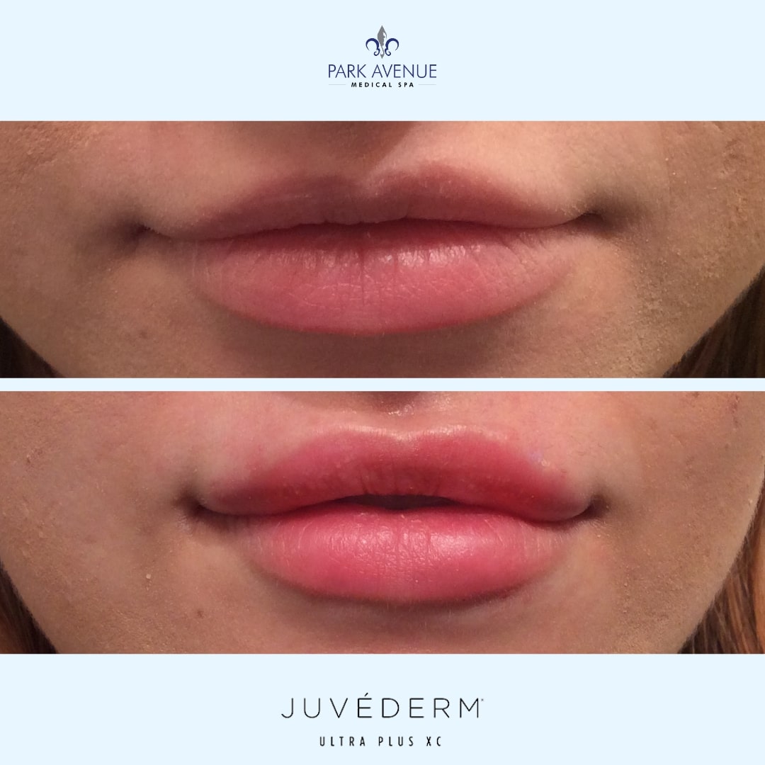 before and after photos of JUVÉDERM treatment on lips
