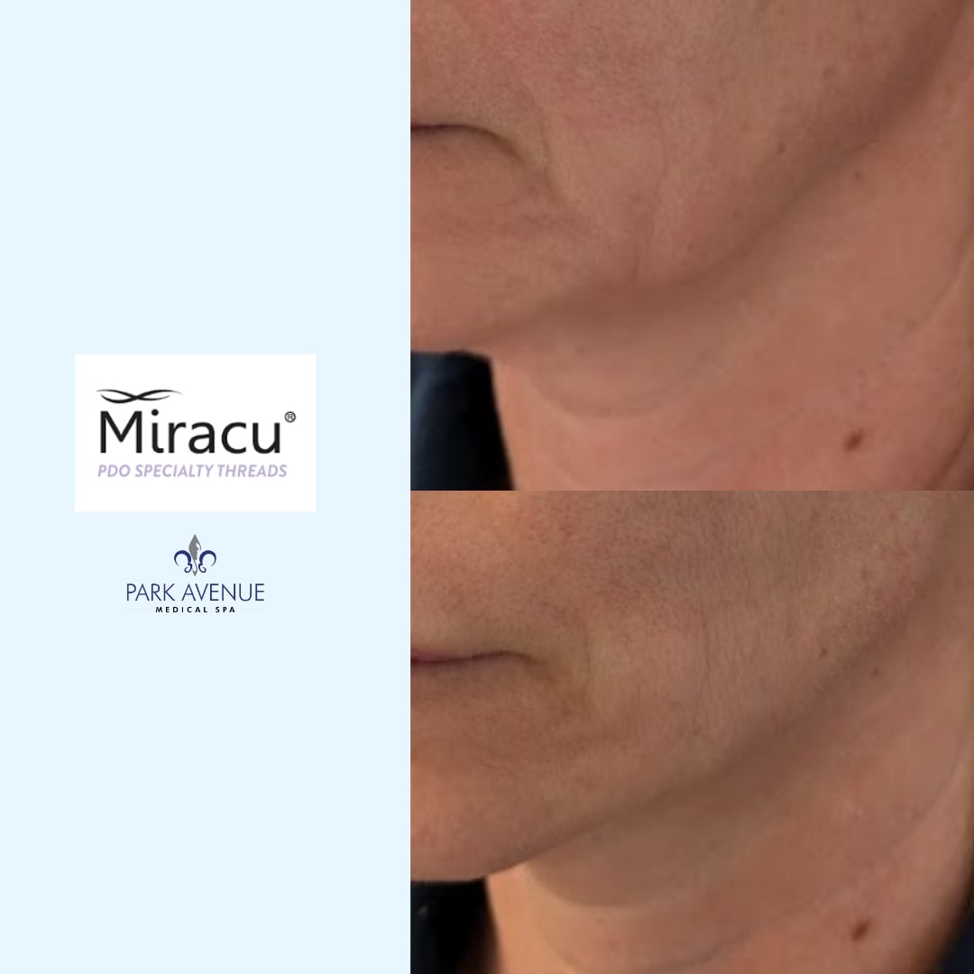 before and after photos of Miracu treatment on jawline