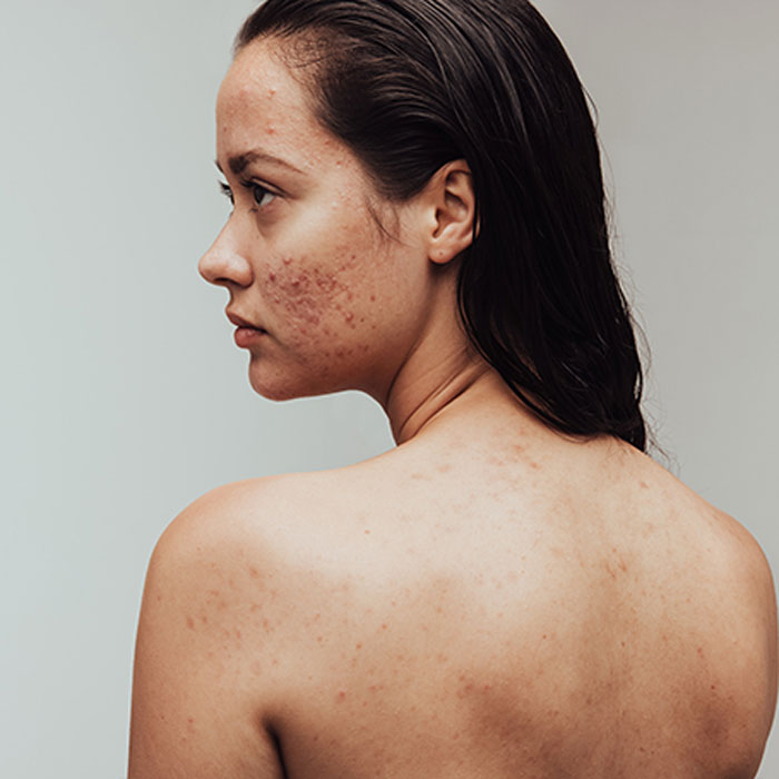 woman with acne on back and face