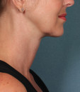 after photo of jawline treatment