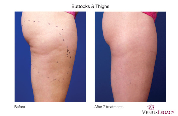 before and after photos of Venus Legacy treatment on buttocks and thighs