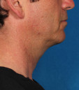 after photo of jawline treatment