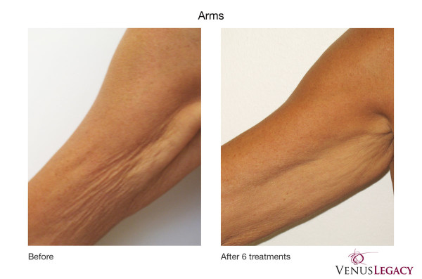 before and after photos of Venus Legacy treatment on arms