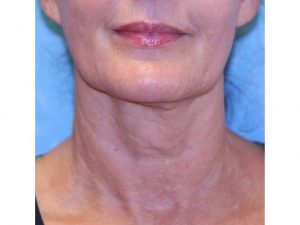 after photo of woman with neck treatment