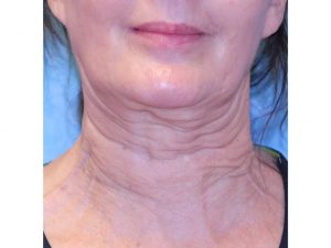 before photo of woman with neck treatment
