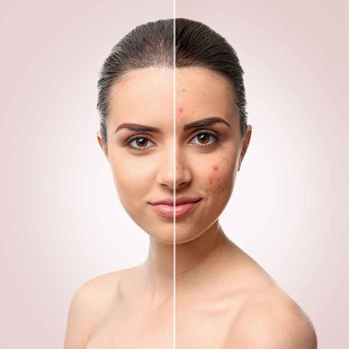 before and after photo of woman with facial acne